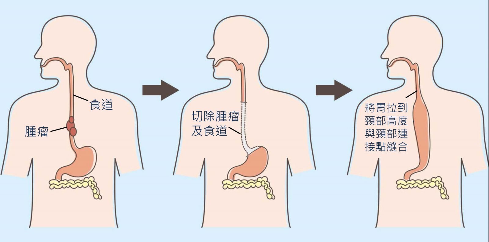 退休1年就罹食道癌2期 爱菸酒肿瘤六公分