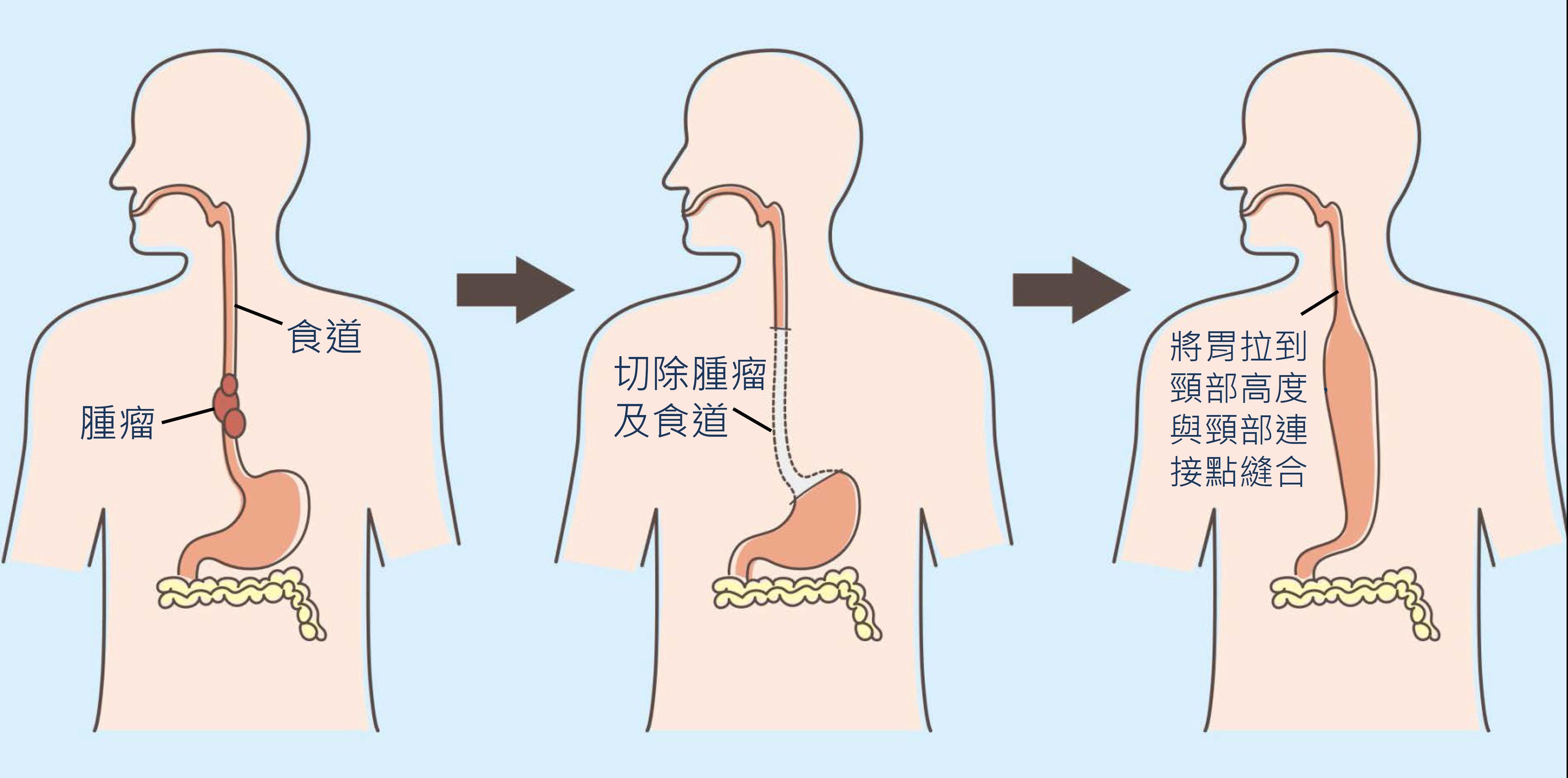 食道图片