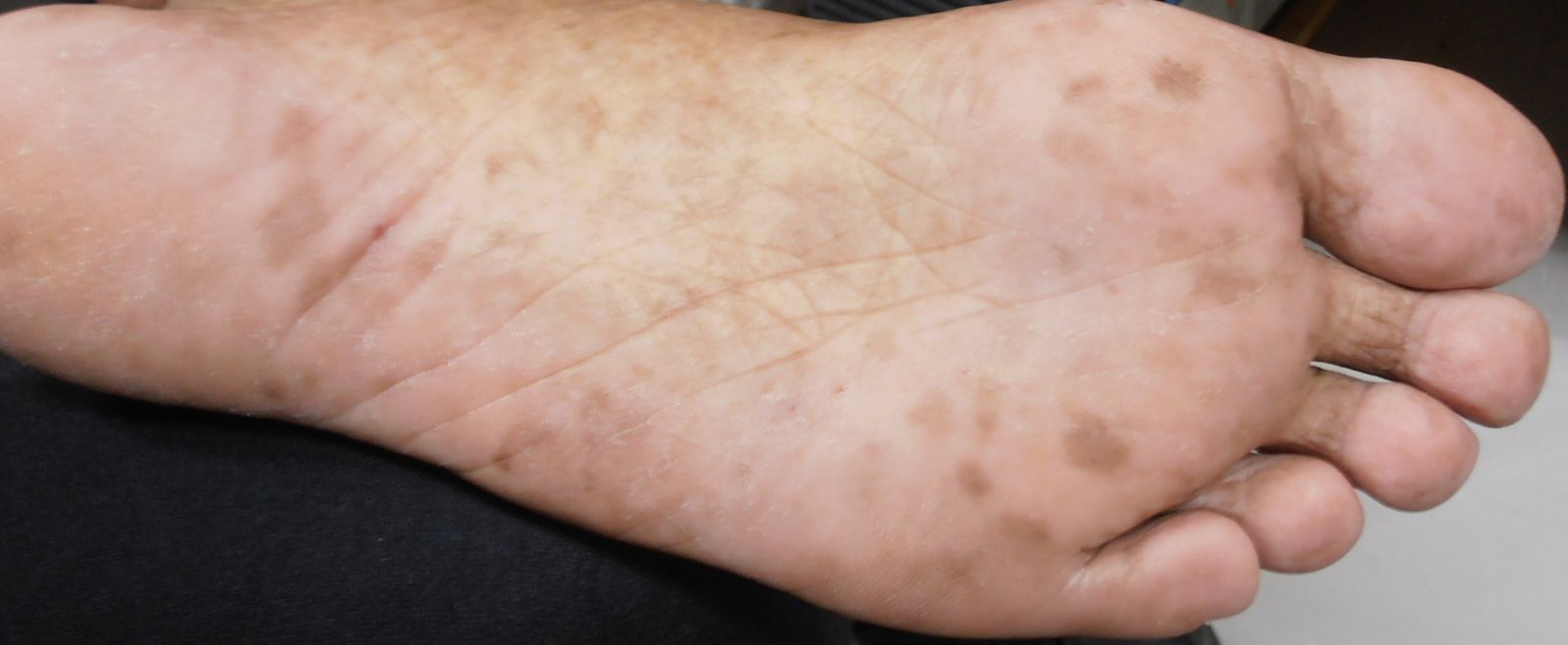 上图:脚底出现多发性黑斑就应该要慎防癌症