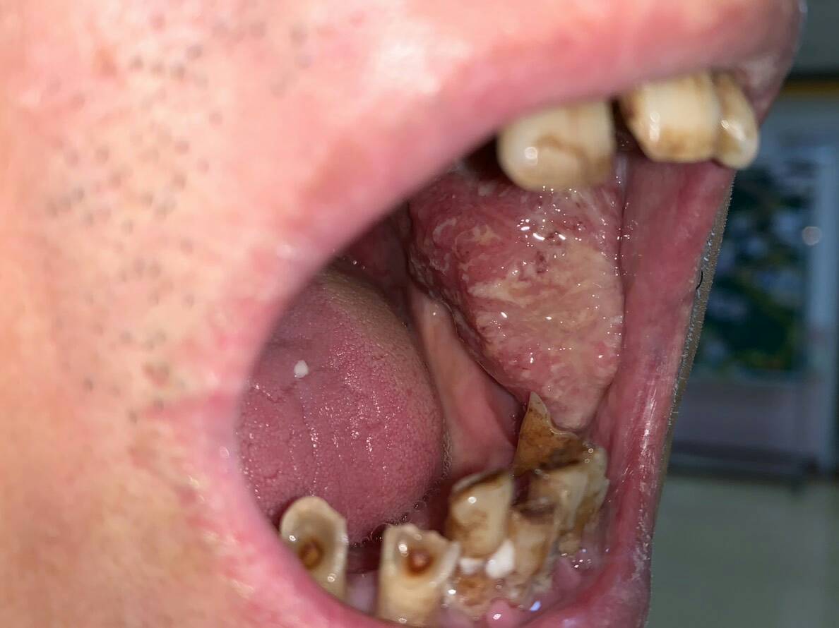 口腔卡波西肉瘤图片图片
